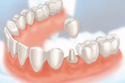 DENTAL-CROWNS