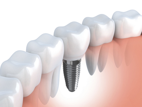 DENTAL-IMPLANTS