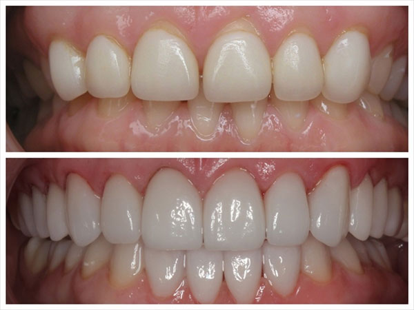 GUM-CONTOURING-FOR-GUMMY-SMILE-GINGIVOPLASTY