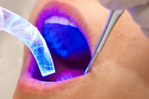 LASER-DENTISTRY