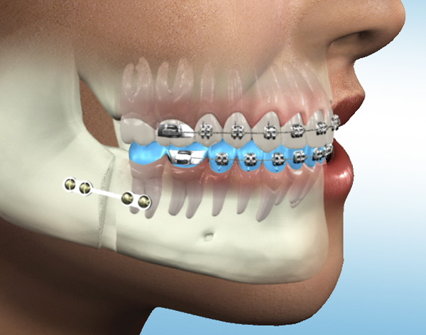 ORAL-MAXILLOFACIAL-SURGERY