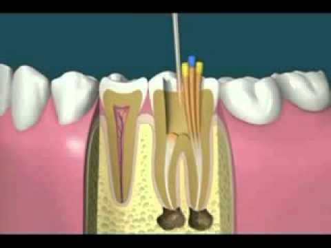 ROOT-CANAL-TREATMENT